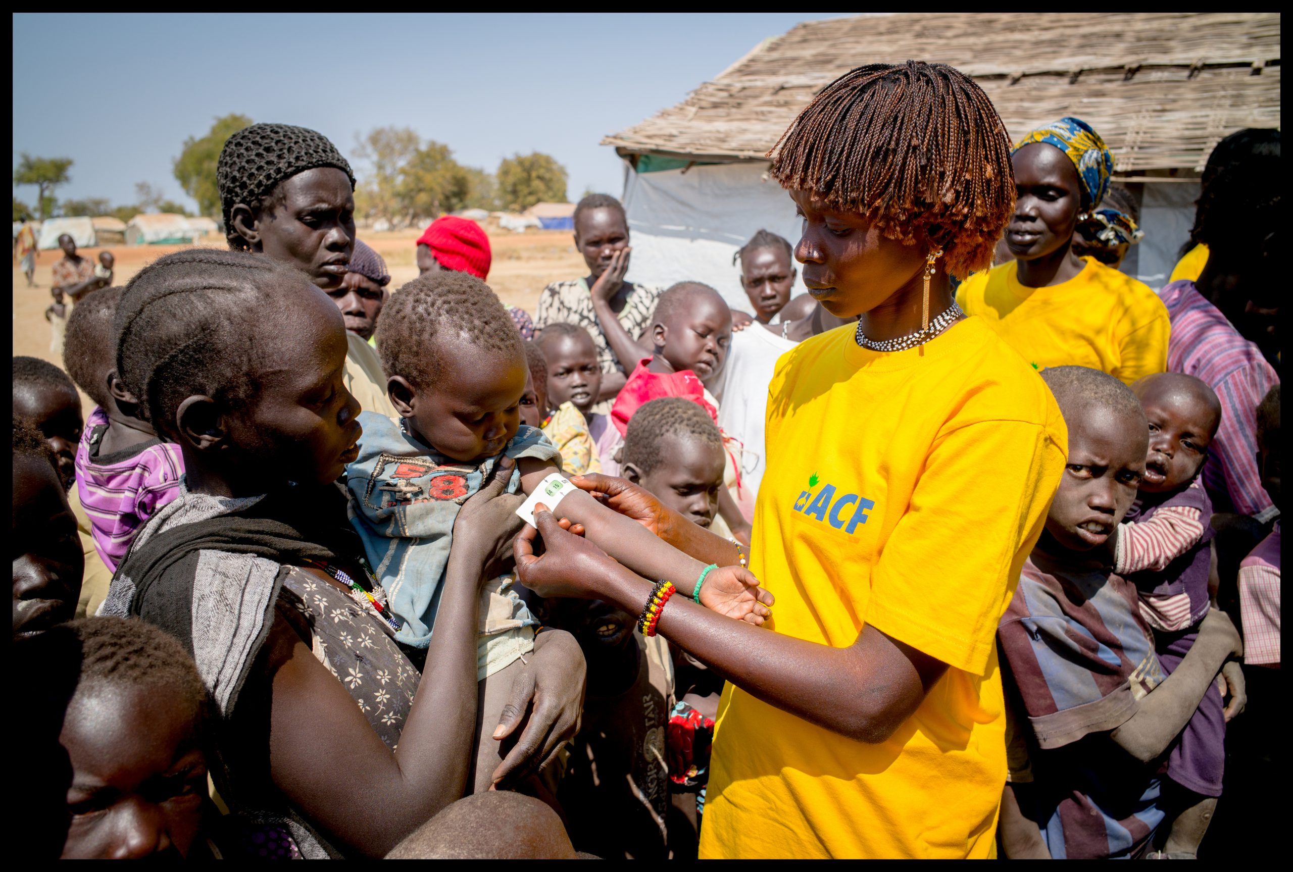 Sud Sudan, fame, malnutrizione, Azione contro la Fame