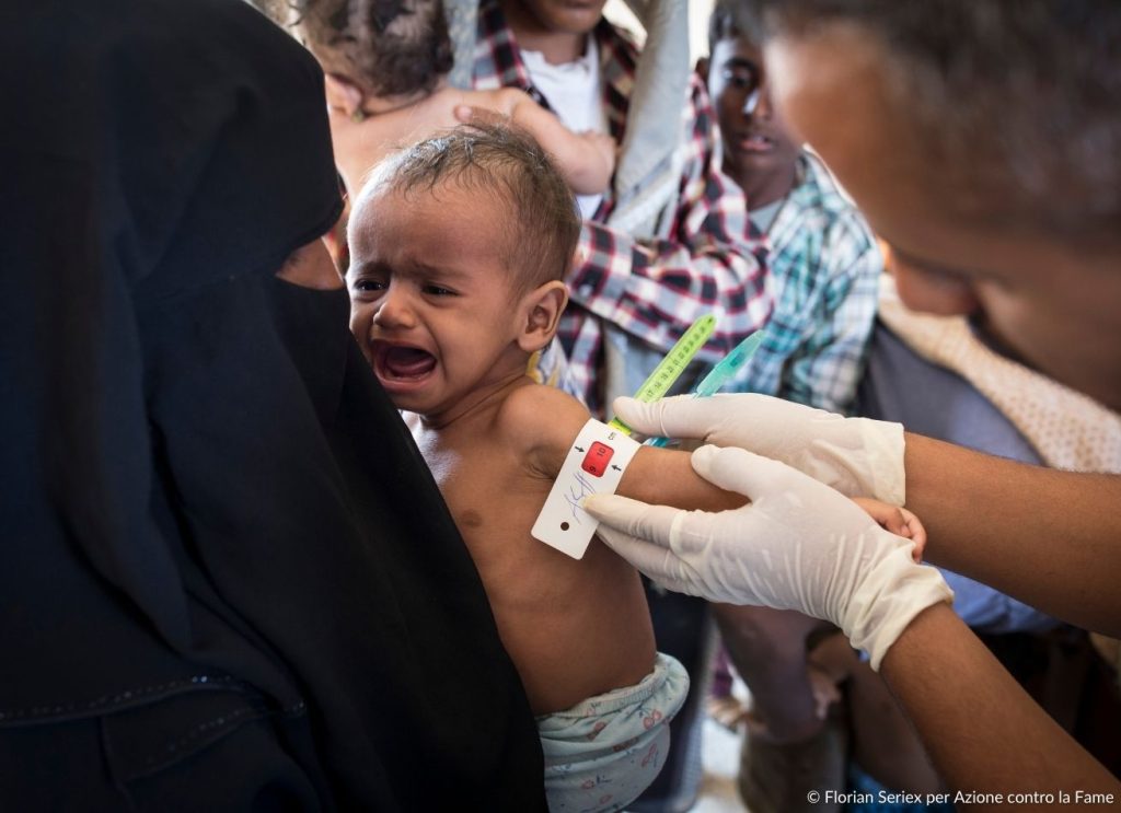 bambino malnutrito per la guerra in Yemen
